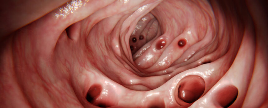 Most People Develop Diverticulosis in Their Gut by 80 … So What Is It? : ScienceAlert