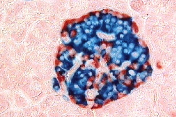 New Treatment May Cure Severe Type 1 Diabetes, Study Finds : ScienceAlert