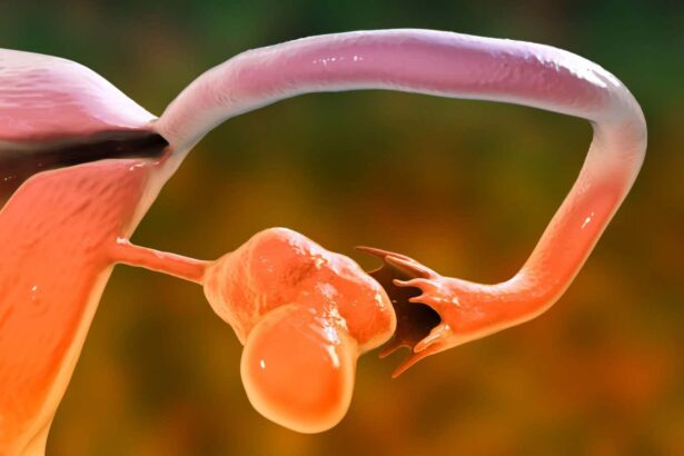 Polycystic ovary syndrome may be passed on via chemical tags on DNA