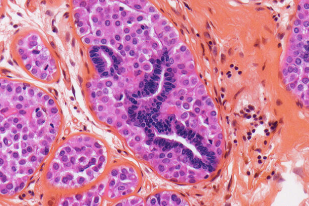 Radiation Therapy Linked to Lower Alzheimer’s Risk, Study Finds : ScienceAlert