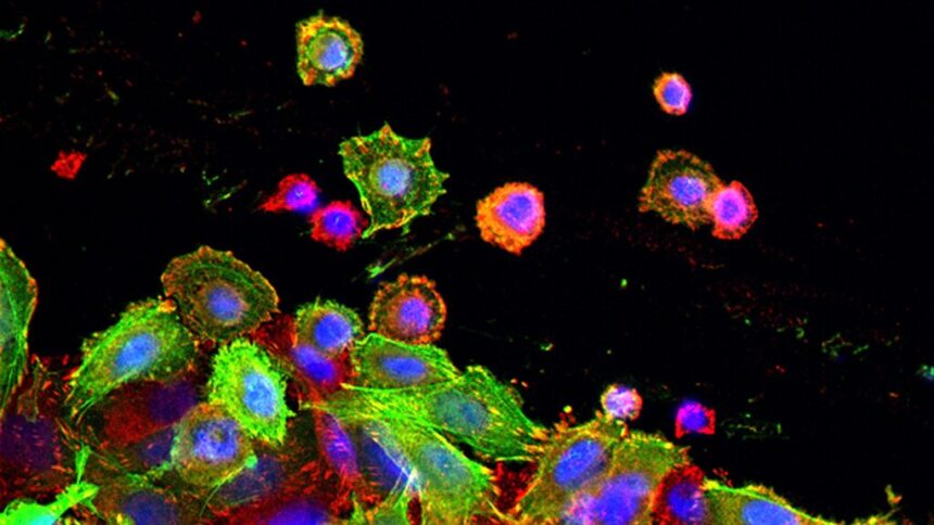 Study finds exercise can keep colon cancer from recurring
