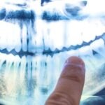 The Cause of Alzheimer’s Might Be Coming From Within Your Mouth : ScienceAlert