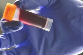 Your Blood Type Affects Your Risk of an Early Stroke, Study Finds : ScienceAlert