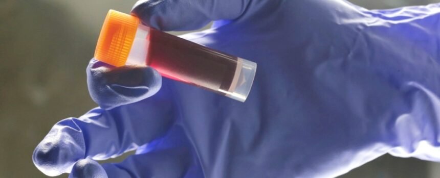 Your Blood Type Affects Your Risk of an Early Stroke, Study Finds : ScienceAlert