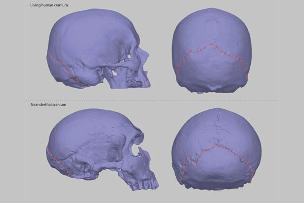 A Neanderthal-shaped skull may explain why some people get headaches