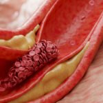A molecule produced by gut microbes may help spur heart disease