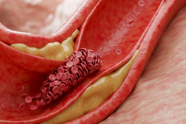 A molecule produced by gut microbes may help spur heart disease