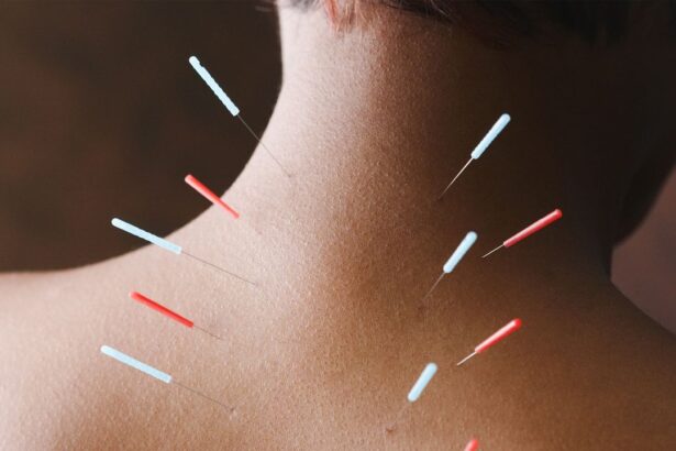 The Benefits of Acupuncture, From Stress Relief to Facial Balancing