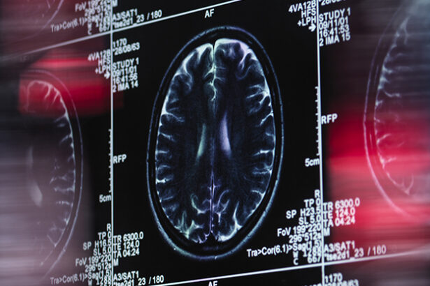 Dementia Linked With Treatment For Chronic Lower Back Pain : ScienceAlert