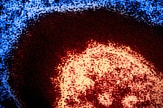 Measles Can Erase Your Immune System’s Memory, Expert Says : ScienceAlert