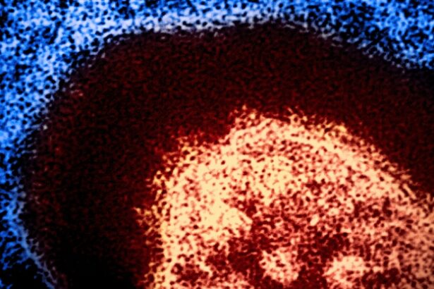 Measles Can Erase Your Immune System’s Memory, Expert Says : ScienceAlert
