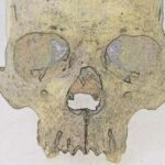 Mysterious Leprosy Pathogen Has Lurked in The Americas For 4,000 Years : ScienceAlert
