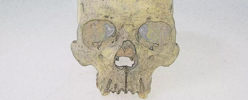 Mysterious Leprosy Pathogen Has Lurked in The Americas For 4,000 Years : ScienceAlert