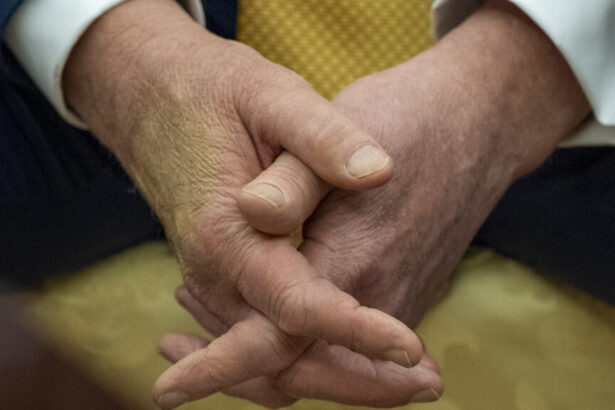 President Trump diagnosed with chronic venous insufficiency