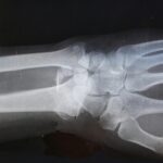 Study finds stopping HRT leads to a period of higher risk of bone fracture for most women