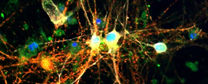 Surprise Discovery About Sugar in The Brain Could Help Fight Alzheimer’s : ScienceAlert