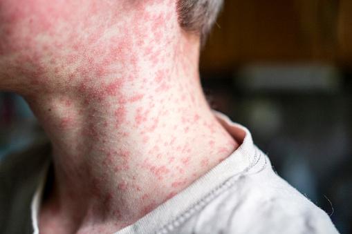 Three measles cases in Wairarapa
