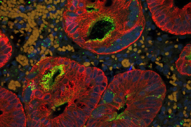 U.S. measles cases break 33-year record, ‘kind of a new normal’