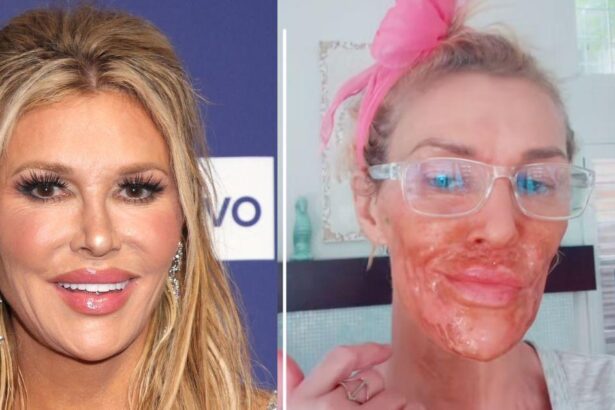 Burns Face With Hair Removal Cream