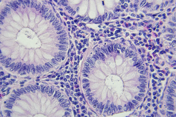 Colon cancer screening guideline change saved lives, studies say
