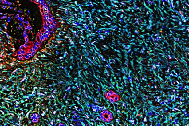 Peptide vaccine shows promise in averting pancreatic cancer relapse