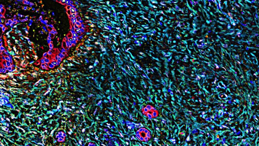 Peptide vaccine shows promise in averting pancreatic cancer relapse