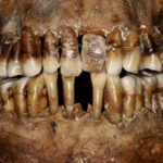 This 17th-Century Aristocrat Had a Clever Secret For Keeping Her Teeth : ScienceAlert