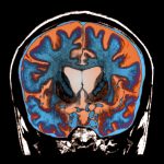 Huntington’s progression slowed by experimental gene therapy