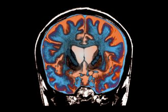 Huntington’s progression slowed by experimental gene therapy