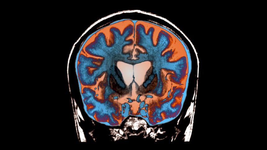 Huntington’s progression slowed by experimental gene therapy