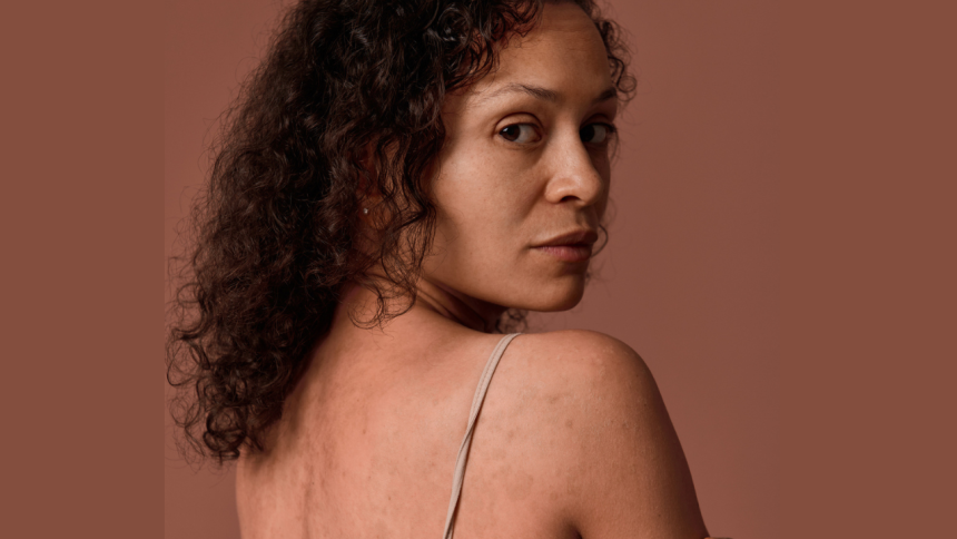 The Ultimate Guide To Caring For Ruddy Skin Without Overdoing It