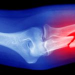 A handheld ‘bone printer’ shows promise in animal tests