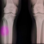 A modified hot glue gun can mend broken bones