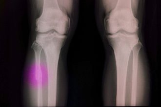 A modified hot glue gun can mend broken bones