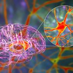 Huntington’s disease breakthrough: what to know about the gene therapy