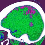 Where you store fat may influence the effect it has on your brain