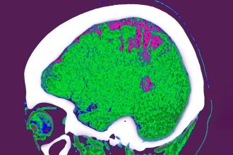 Where you store fat may influence the effect it has on your brain