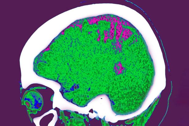 Where you store fat may influence the effect it has on your brain