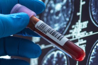 World Alzheimer’s Day: Here’s How Far We’ve Come in Search of a Cure
