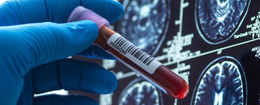 World Alzheimer’s Day: Here’s How Far We’ve Come in Search of a Cure