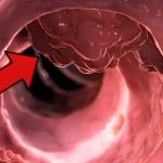A Common Medicine May Stop Colorectal Cancer From Returning
