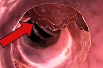 A Common Medicine May Stop Colorectal Cancer From Returning