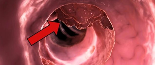 A Common Medicine May Stop Colorectal Cancer From Returning