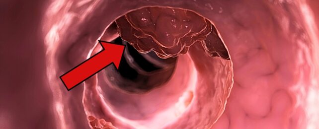 A Common Medicine May Stop Colorectal Cancer From Returning