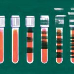 A Simple Blood Test Could Spot Alzheimer’s Early—But It’s Complicated