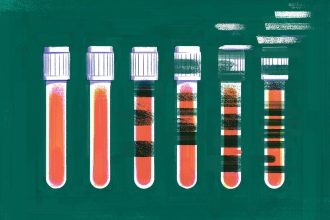 A Simple Blood Test Could Spot Alzheimer’s Early—But It’s Complicated