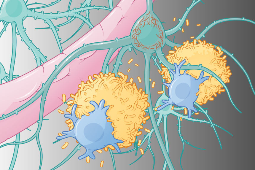 See How Alzheimer’s Disease Works—And How the Newest Treatments Fight It