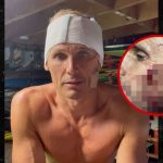 Surfer Jamie Mitchell Suffers Gruesome Cuts in Freak Wipeout