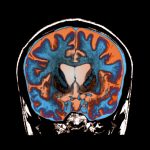 How Scientists Finally Found a Treatment that Slows Huntington’s Disease