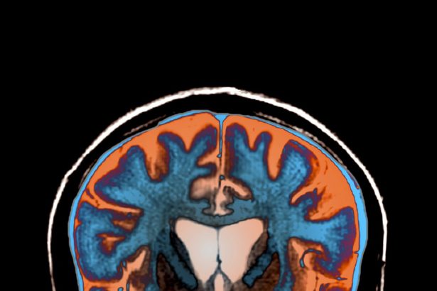 How Scientists Finally Found a Treatment that Slows Huntington’s Disease